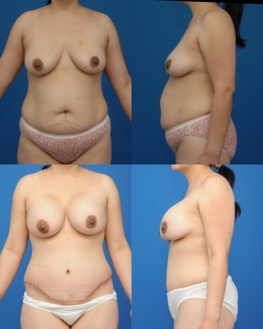 abdominoplasty-with-breast-augmentation-nyc-01