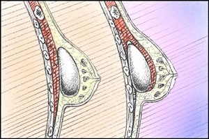 breast enlargement cross-section