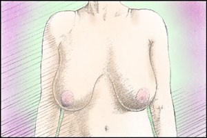 before breast reduction