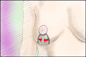 breast reduction surgery