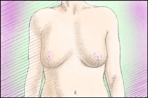 breasts after reduction surgery
