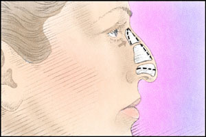 rhinoplasty incisions