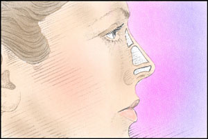 rhinoplasty procedure