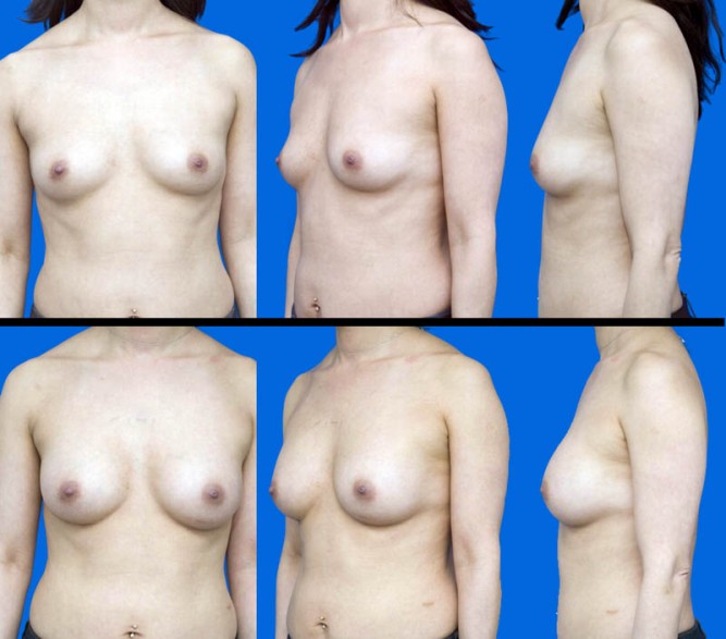 breast-augmentation-011