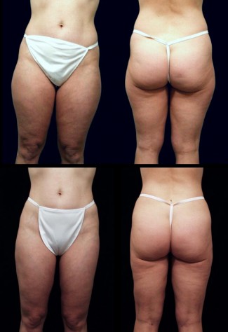 liposuction_1626-new