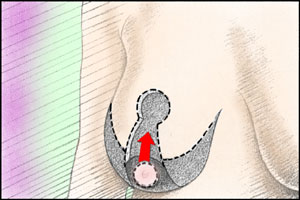 breast reduction incisions